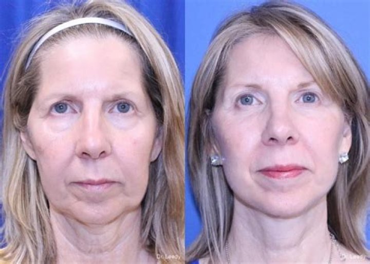 Gloria Borger's Facelift: Before And After Photos And Details