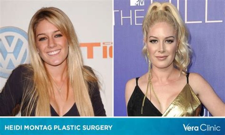 Heidi Montag's Plastic Surgery Transformation: Before And After The Knife