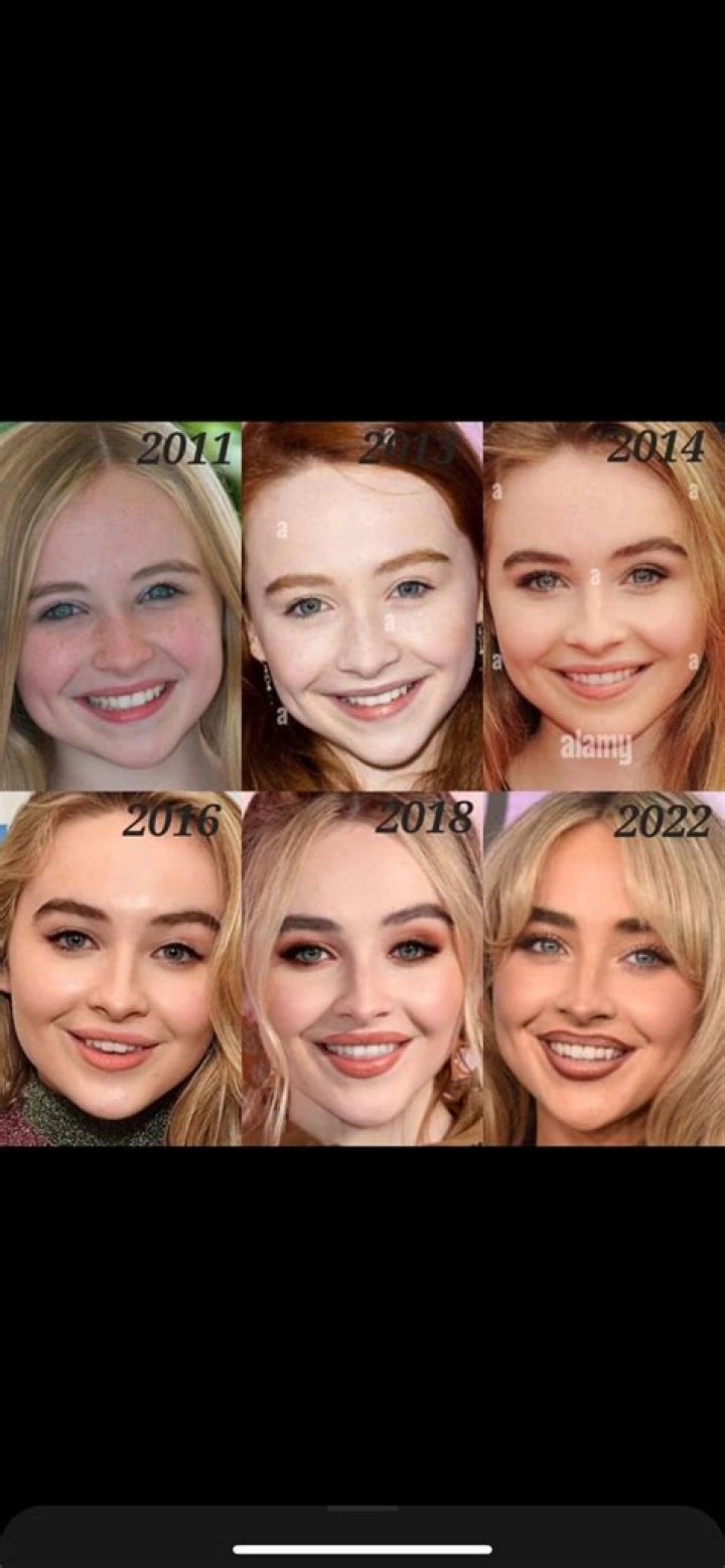 Sabrina Carpenter's Lip Filler Journey: A Candid Look At The Procedure